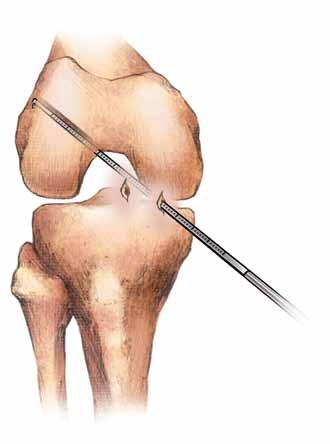 Surgical Technique (continued) Figure 4 Figure 5 AM Femoral Tunnel Preparation (continued) Pass the 4.5mm drill in and out of the cortex two to three times to facilitate passage of the implant.