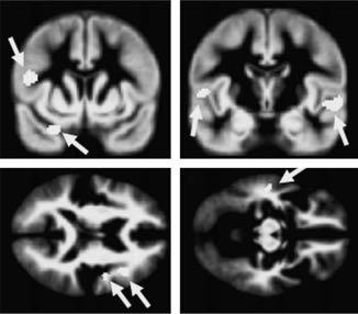 (a) Coronal view of increased grey matter density in left inferior frontal gyrus and left temporal pole at coordinate y.10.