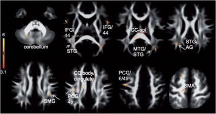 Figure 1 White matter regions showing significant group differences in fractional anisotropy based on wholebrain analysis (TBSS).