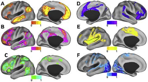 -E., et al. Anomalous network architecture of the resting brain in children who stutter. Journal of Fluency Disorders (2017), http://dx.doi.org/10.1016/j.jfludis.2017.01.002 Fig. 6.