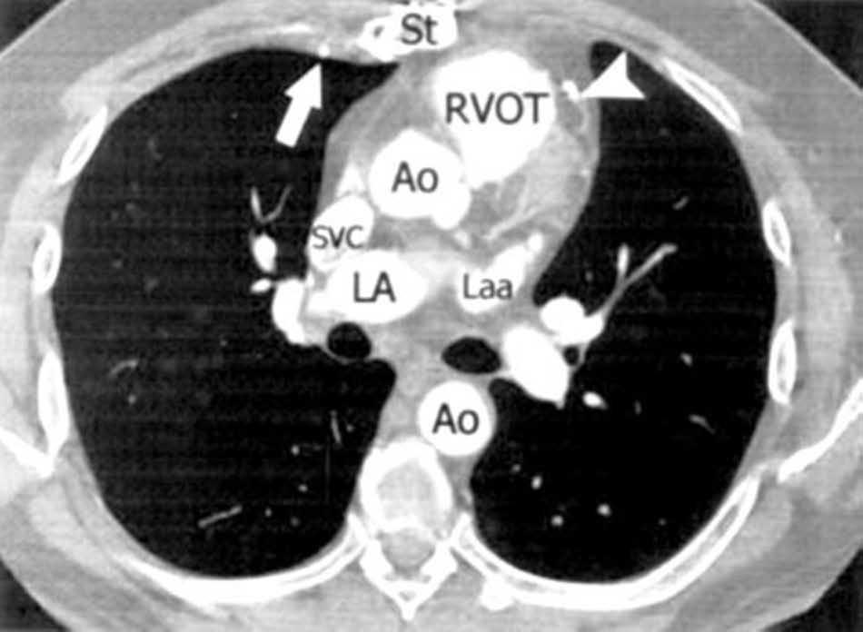 Figure 1. Axial CT image in a patient with an in situ LIMA bypass.