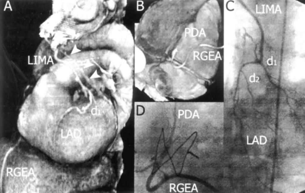 Figure 3. Three-dimensional volume-rendering CT images (left, A, and top center, B) and corresponding conventional angiograms (right, C, and bottom center, D) in a patient with arterial grafts.