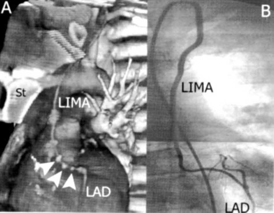 The RGEA is used for the second graft course along the anterior hepatic surface (left, A) and the inferior cardiac surface (top center, B), where it is anastomosed to the PDA (top center, B; and