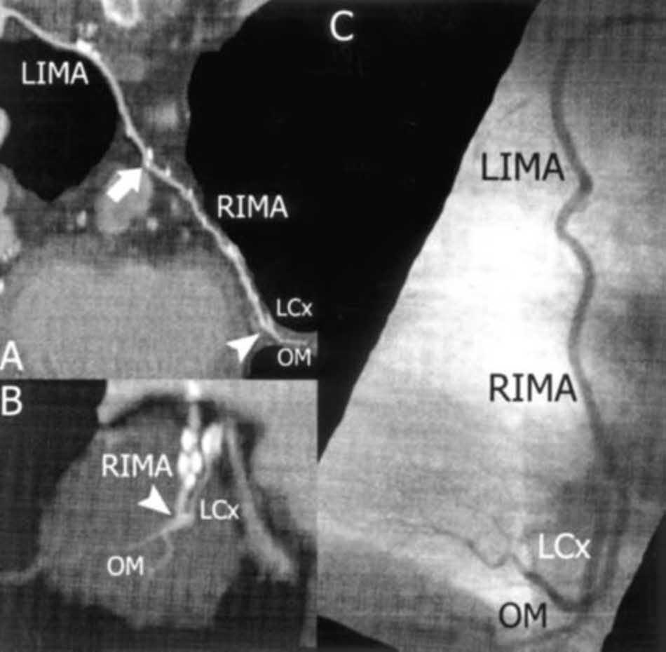 Figure 5. Curved MPRs (top left, A, and bottom left, B) and corresponding conventional angiogram (right, C) in a patient with a Y free grafted RIMA between the LIMA and the OM of the LCx.