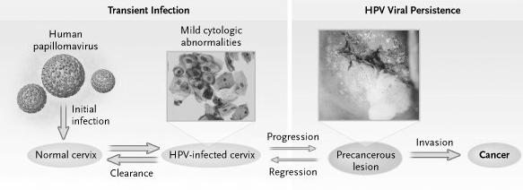Stages of Cancer Progression Natural History of HPV and Cervical Cancer Over the Lifespan Wright TC Jr, Schiffman M. N Engl J Med.