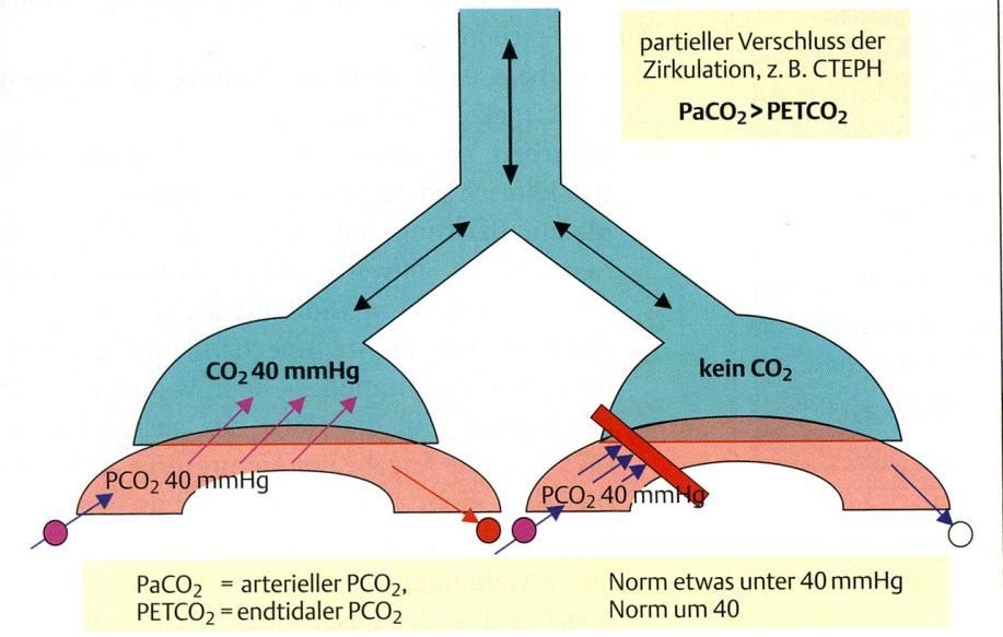 Rationale for measurement of PETCO 2 during exercise pulmonary vascular disease Mismatch between perfusion and ventilation: Poor perfusion, good ventilation PaCO 2 > PETCO 2 pulmonary vascular