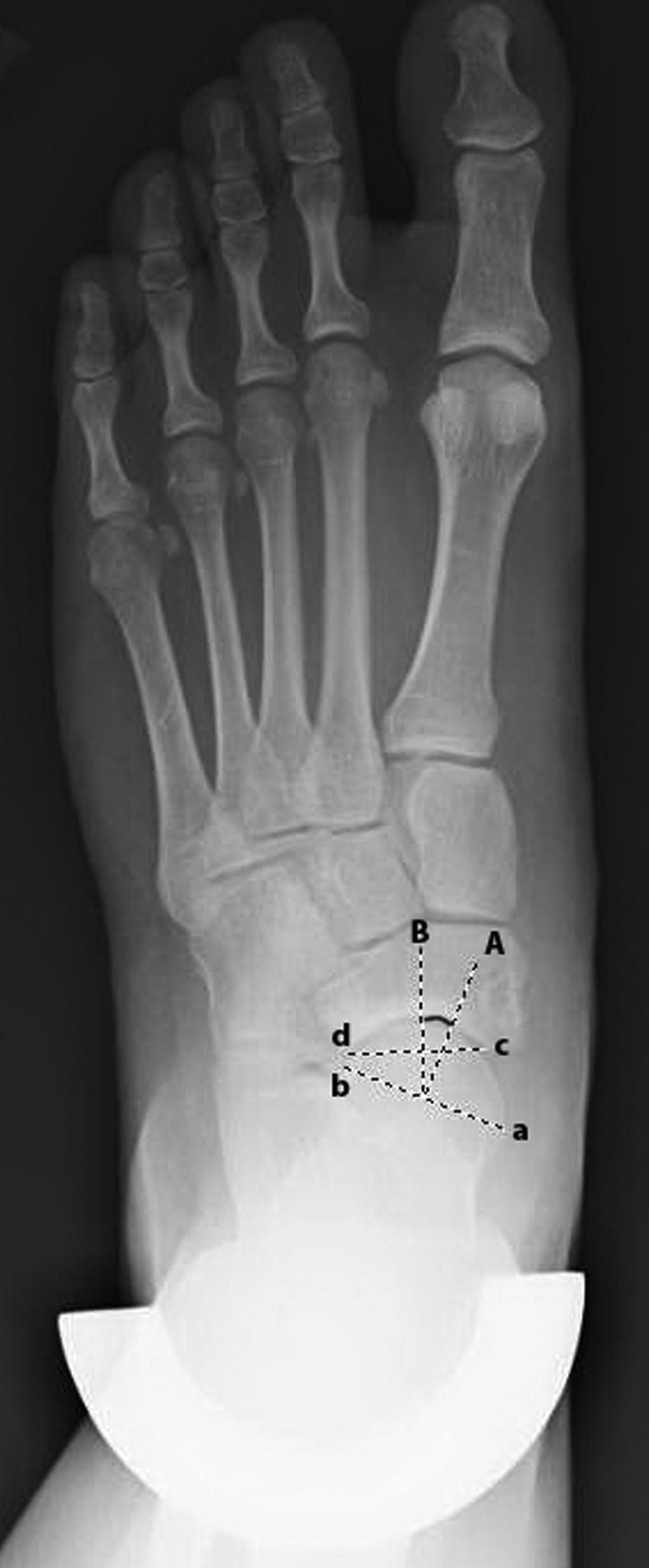 Index: Diagnostic Accuracy in Symptomatic Flatfoot and Cavovarus Foot: Part 2 Fig.