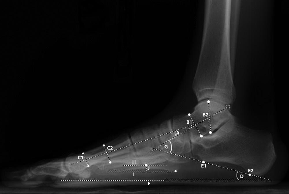 The lateral talo-first metatarsal angle; the longitudinal axis of the talus (line B1-B2) is established by placing a mark at the halfway point between the superior and inferior surfaces of the talus
