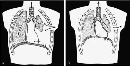 HISTORY OF ANAETHESIA FOR THORACIC SURGERY Figure 1. When the chest is opened, the lung collapses and the mediastinum shifts towards the non-operated lung.