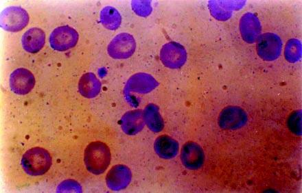 BJID 2003; 7 (October) Rapid Diagnosis of Plasmodium falciparum Malaria 335 Table 1.