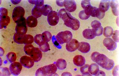 336 Rapid Diagnosis of Plasmodium falciparum Malaria