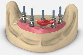 full-arch restorations verification jig fabrication 3 Lab step - Place the direct impression copings on the model Place implant-level or Multi-unit direct pick-up copings on the model using the long