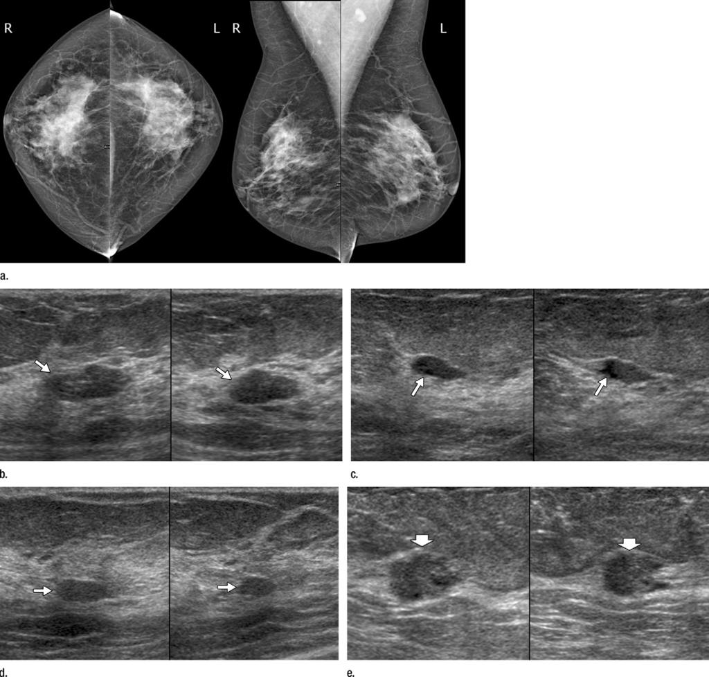 Images in 56-year-old woman with multiple similar bilateral masses at US and cancer. This woman had a lifetime risk for breast cancer of more than 25%.