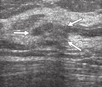 and ultrasound images and recorded features in consensus using the BI-RDS lexicon and the ultrasound cystic mass classification described by Berg and colleagues [13, 14].