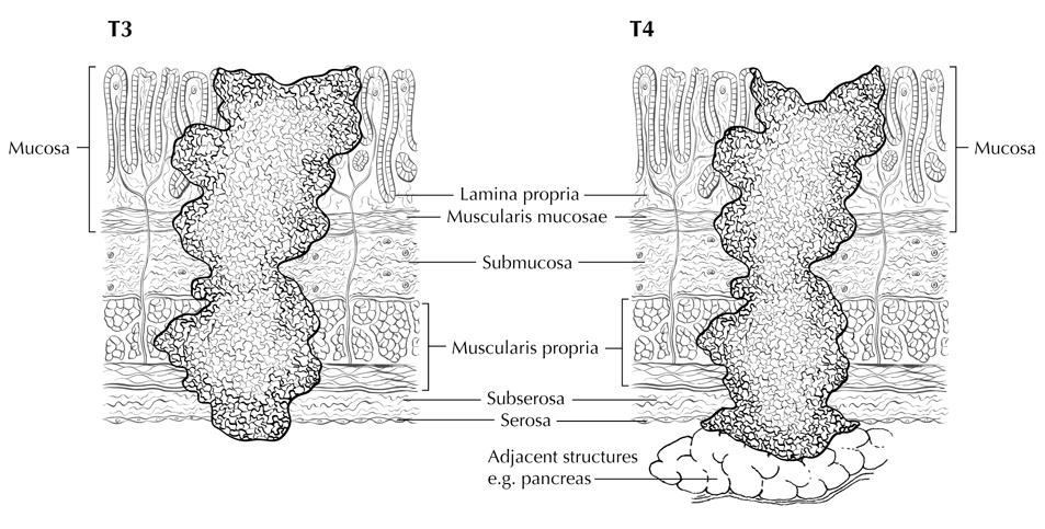 T4a T4b Figure 5. T4a tumor penetrates the serosa (visceral peritoneum) without invasion of adjacent structures, whereas T4b tumor invades adjacent structures, such as the pancreas (shown).