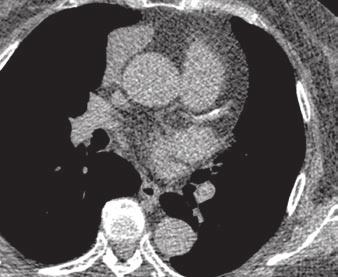 Kim et al. smokers who came to the health care center of our institute to undergo low-dose chest CT for lung cancer screening and calcium-scoring CT for coronary risk factors.