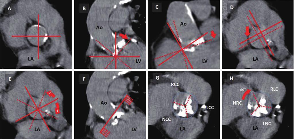 Annals of cardiothoracic surgery, Vol 1, No 2 July 2012 161 Figure 1 Aortic Valve Calcium Scoring (AVCS): Step by step. A: Place the crosshair on the aortic sinus in a transverse section.