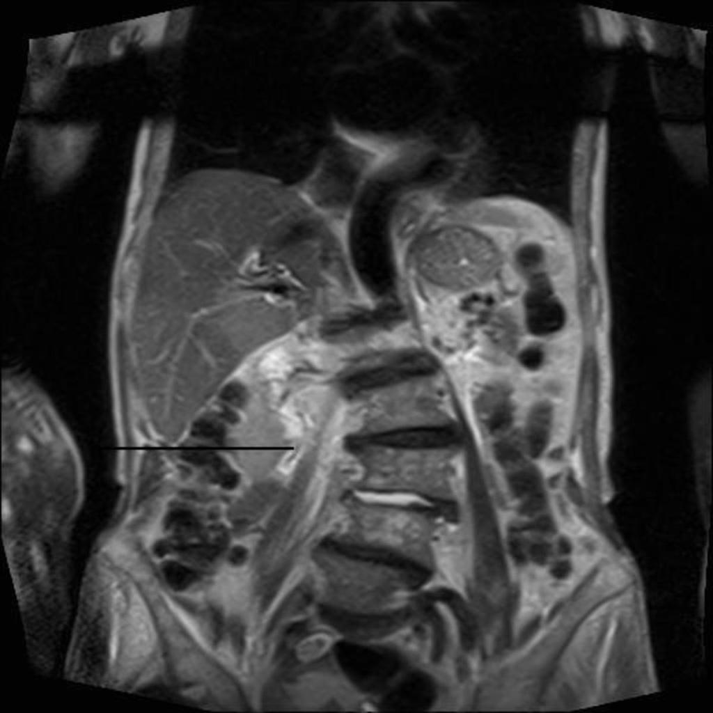 Fig.: fig 10 Axial CT showing an abnormal right psoas muscle in a lady who presented with back pain [fig 7].