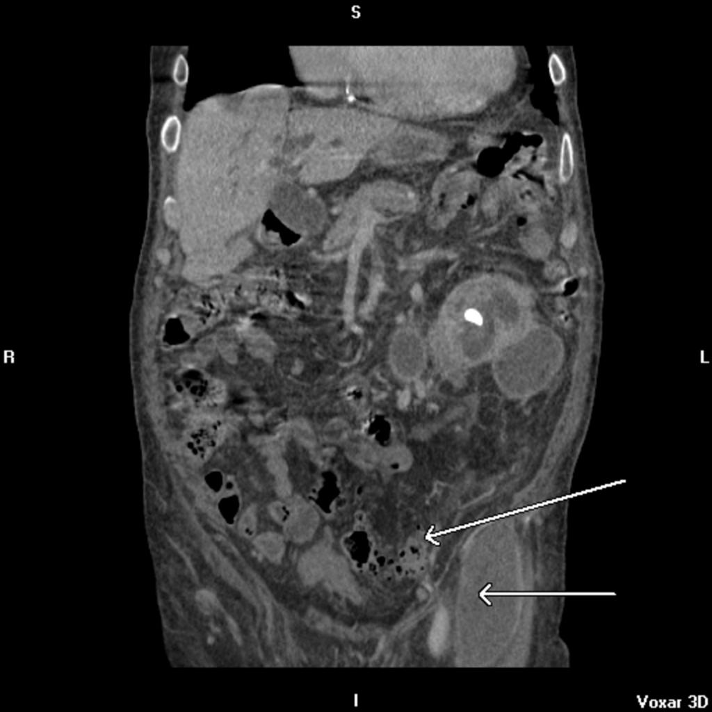 Fig.: fig 13 A left iliopsoas abscess [fig11]. arising from an obstructed, infected left renal system due to a proximal ureteric stone [fig12].