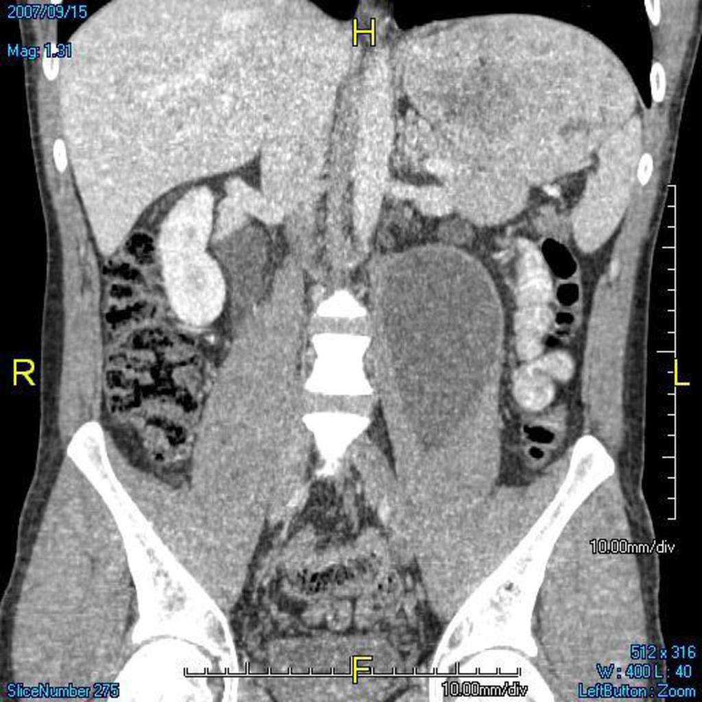 Fig.: fig 17 44 yr old asian lady came with a 4 month history of left sided back pain. She had a history of tuberculosis 2 years ago. CT showed a thick walled left psoas abcess. Fig [16,17].