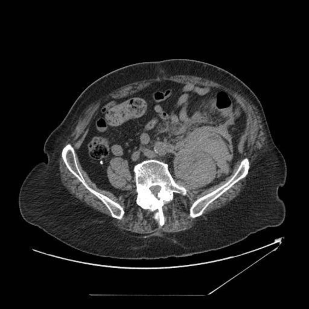 The CT appearances vary depending on the age of the haematoma. Recent haemorrhage will appear as a high attenuation mass. A fluid-fluid level may be seen.