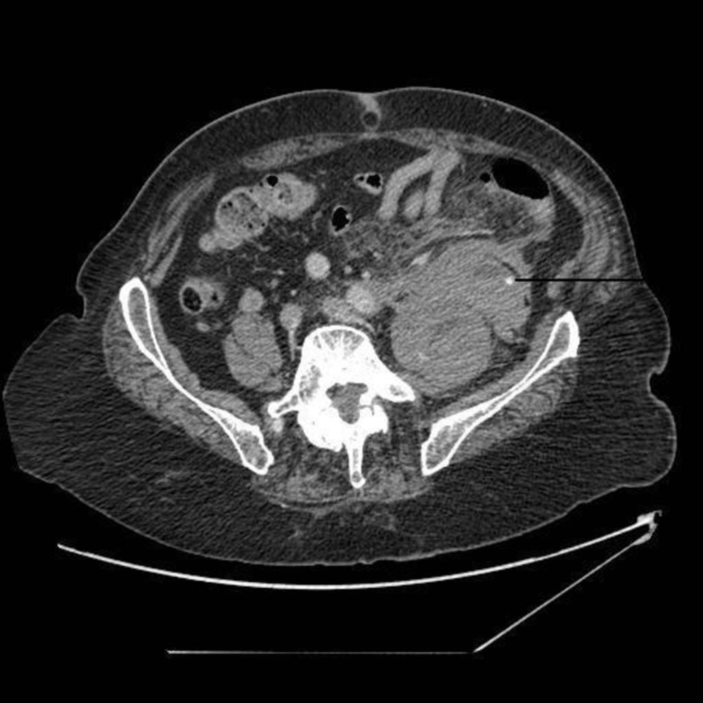 Fig.: fig 20 Fig: 18,19,20. 72 year old man presented with left sided back pain. He was tachycardic and the initial clinical diagnosis was a possible leaking abdominal aortic aneurysm.
