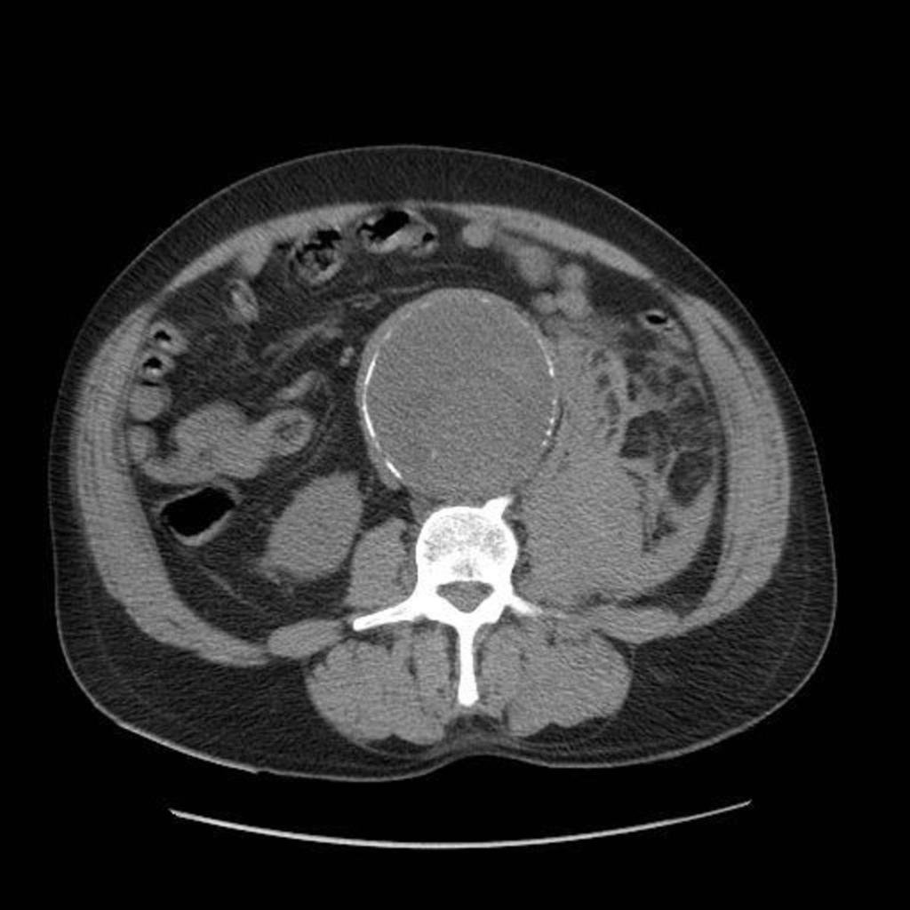 Fig.: fig 22 Fig 22: Unenhanced axial CT image shows a leaking abdominal aortic aneurysm Tumour Tumor involvement of the iliopsoas muscle is most often secondary to direct extension of an adjacent