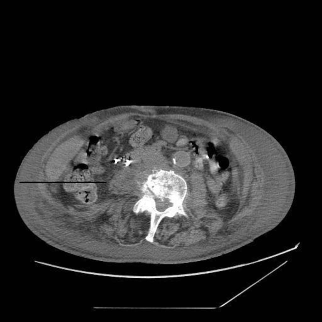 aorta, bowel or pancreas. Primary pyogenic abcess are extremely rare and are usually idiopathic.