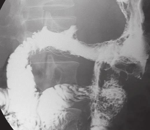 Stent Placement for Malignant Gastroduodenal Obstruction Fig. 2 Radiographs obtained during placement of dual stent in 49-year-old man with gastric cancer involving gastric outlet.