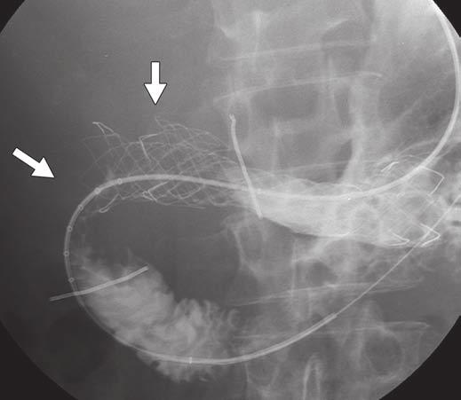 B, Passage of injected contrast medium through multipurpose coil catheter shows tumor overgrowth (arrows) from distal part of dual stent to second portion of duodenum 349 days after placement of dual