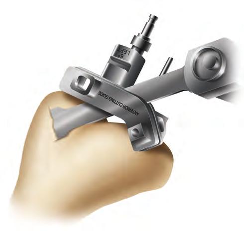 Femoral Preparation Preliminary Anterior Femoral Resection 1.Release and remove the modular paddles, if applicable.
