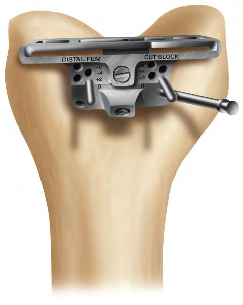 Resect the distal femur (Figure 17), then remove the distal femoral cutting block.