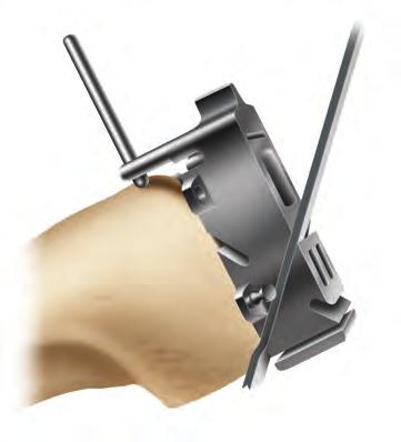 Tip: The A-P cutting block should seat flush with the cut anterior and distal surfaces.