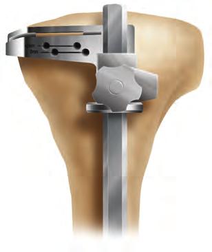 For tibial preparation using the extramedullary guide with a spiked rod, turn to page 17. Extramedullary Tibial Alignment gold knob Instrument Assembly: a.