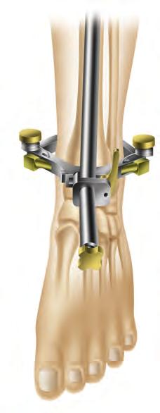After the ankle clamp is moved into the proper position, lock into place with the gold knob. c. Choose the correct left or right tibial cutting block. Select the spiked or non-spiked fixation rod.