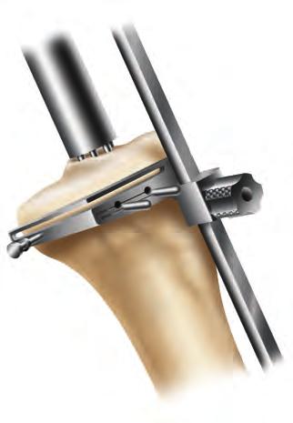 The stylus can be adjusted for a 9, 11 or 13mm tibial resection by twisting the knob on top of the stylus. 3.