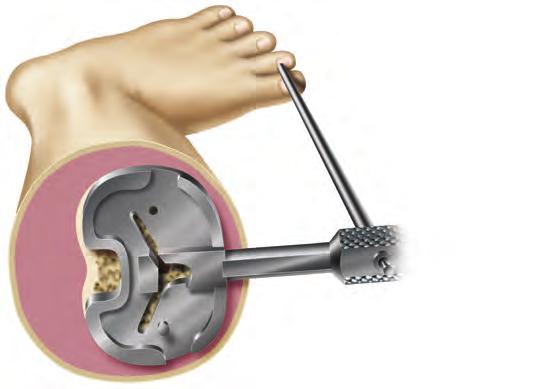 Tibial Sizing Option A Stemless Tibial Trials 1.Attach a quick-connect handle to a stemless trial one size below the femoral component size and place on the cut tibia to assess coverage (Figure 51).