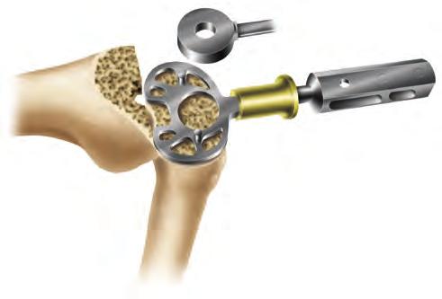Option B Stemmed Tibial Trials 1.Place a tibial drill guide one size below the femoral component size on the cut tibia to assess coverage. As needed, additional sizes should be templated (Figure 53).