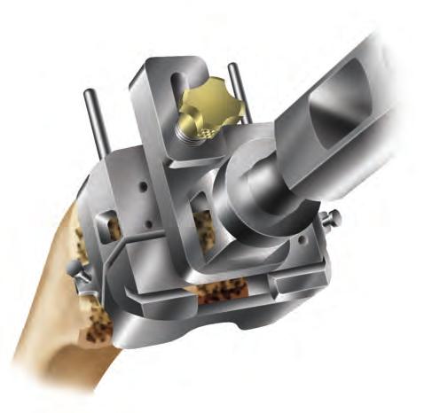 4.Ream through the housing resection collet until the automatic depth stop contacts the collet, loosen the thumbscrew and then move the reamer anterior