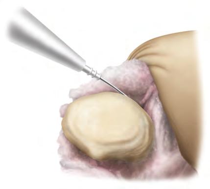 Use a rongeur to remove osteophytes and reduce the patella to its true size (Figure 66). The bovie should also be used to release soft tissue attachments to the estimated level of resection. 3.