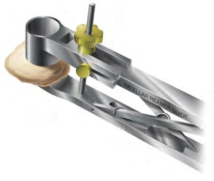 implant, and select the correctly-sized patellar reamer