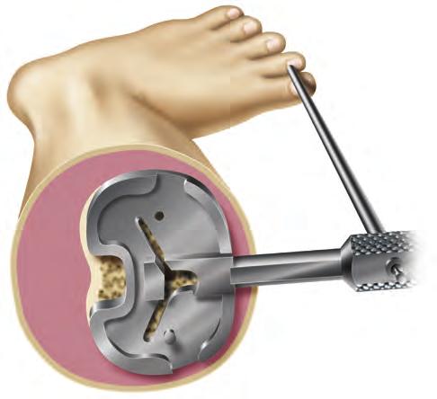 Option: Extend the knee fully with the handle attached to the tibial trial.