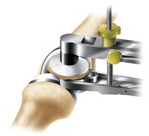 Patellar Implantation 1. Assemble the patellar cement clamp to the patellar reamer guide. 2.Apply bone cement to the patella. 3.