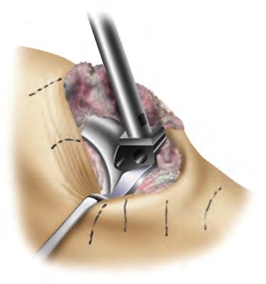 Tip: Lift the distal femur to prevent scratching of the posterior condyle of the component. 2.