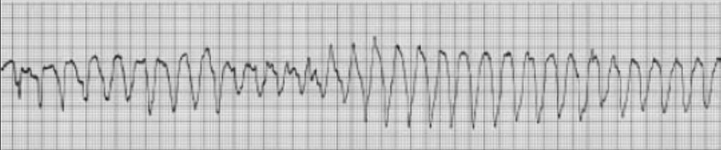 Torsades de Pointes Polymorphic Ventricular Best treated with magnesium RHY Chaotic waves R None PRI None QRS Points twist Chaotic wavy line No pulse Points twist Agonal Dying heart Drugs used in