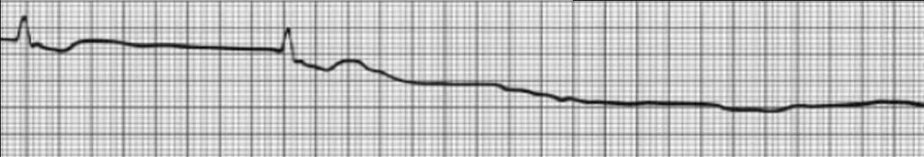 unless only Ps R No Vent rate P May be present QRS None Straight line or only Ps No Pulse Calculating Heart Rate - note strips on pretest are longer than 6 seconds.