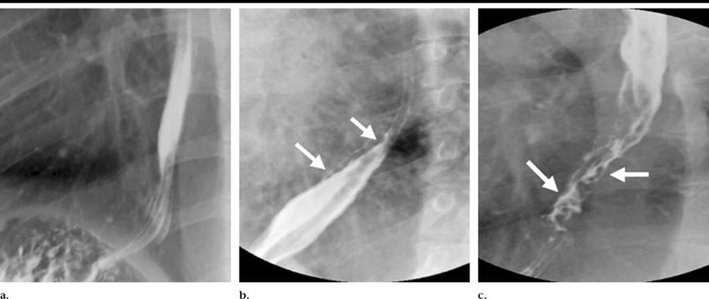 Figure 1. Left posterior oblique barium esophagrams. (a) Patient without EV (grade 0). (b) Patient with small EV (grade 1) (arrows).