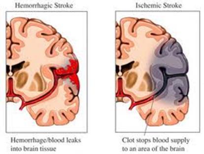 Types of Stroke Divided into ischemic or hemorrhagic