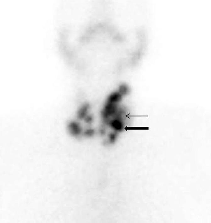 [Downloded free from http://www.ijem.in on Wednesdy, Septemer 28, 2016, IP: 85.150.20.164] Chudhry nd Bno: Thyroid imging Figure 1: Multinodulr goiter.