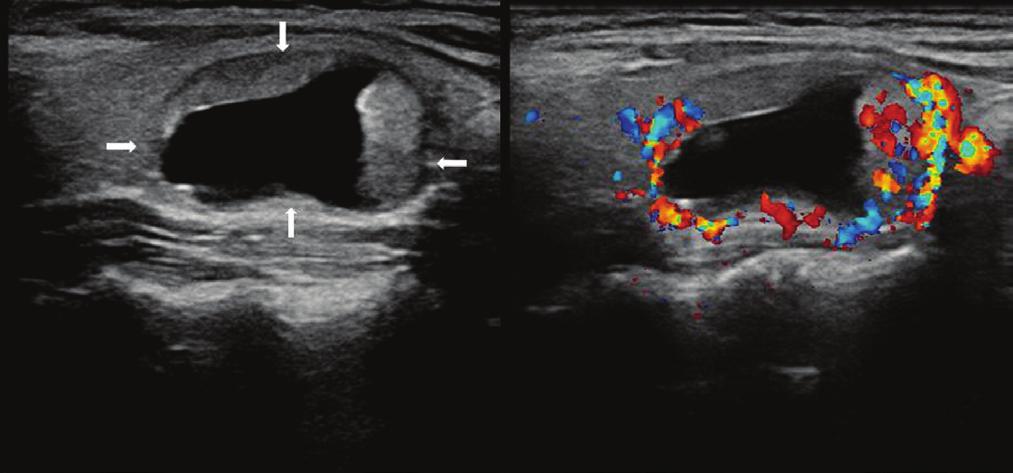 Trnsverse gry-scle ultrsound () nd color Doppler () neck, of 40-yer-old femle ptient, shows lrge well circumscried iso-hypoechoic solid thyroid nodule with multiple internl cystic spces (rrow) nd oth